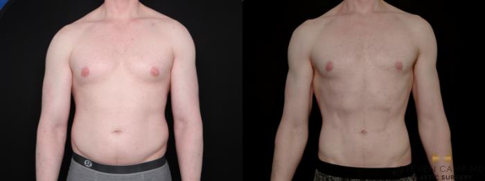Before & After Liposuction Case 790 Front View in Fort Worth & Arlington, Texas