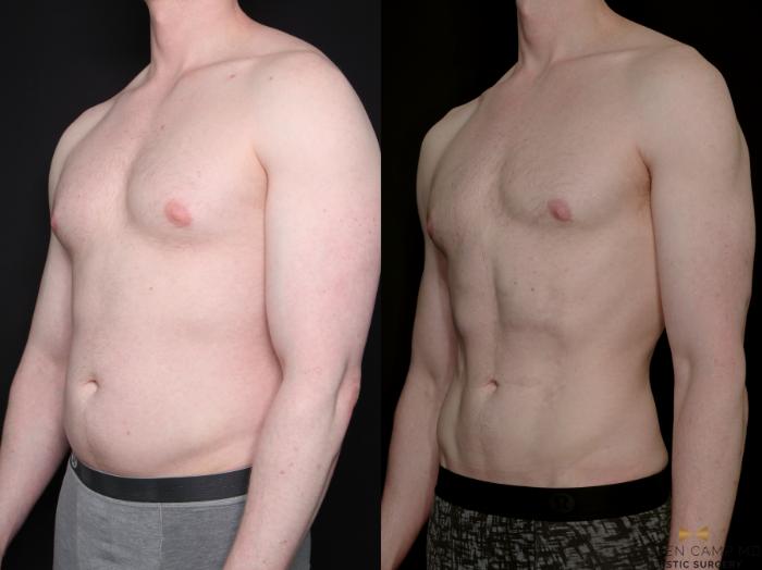 Before & After Liposuction Case 790 Left Oblique View in Fort Worth & Arlington, Texas