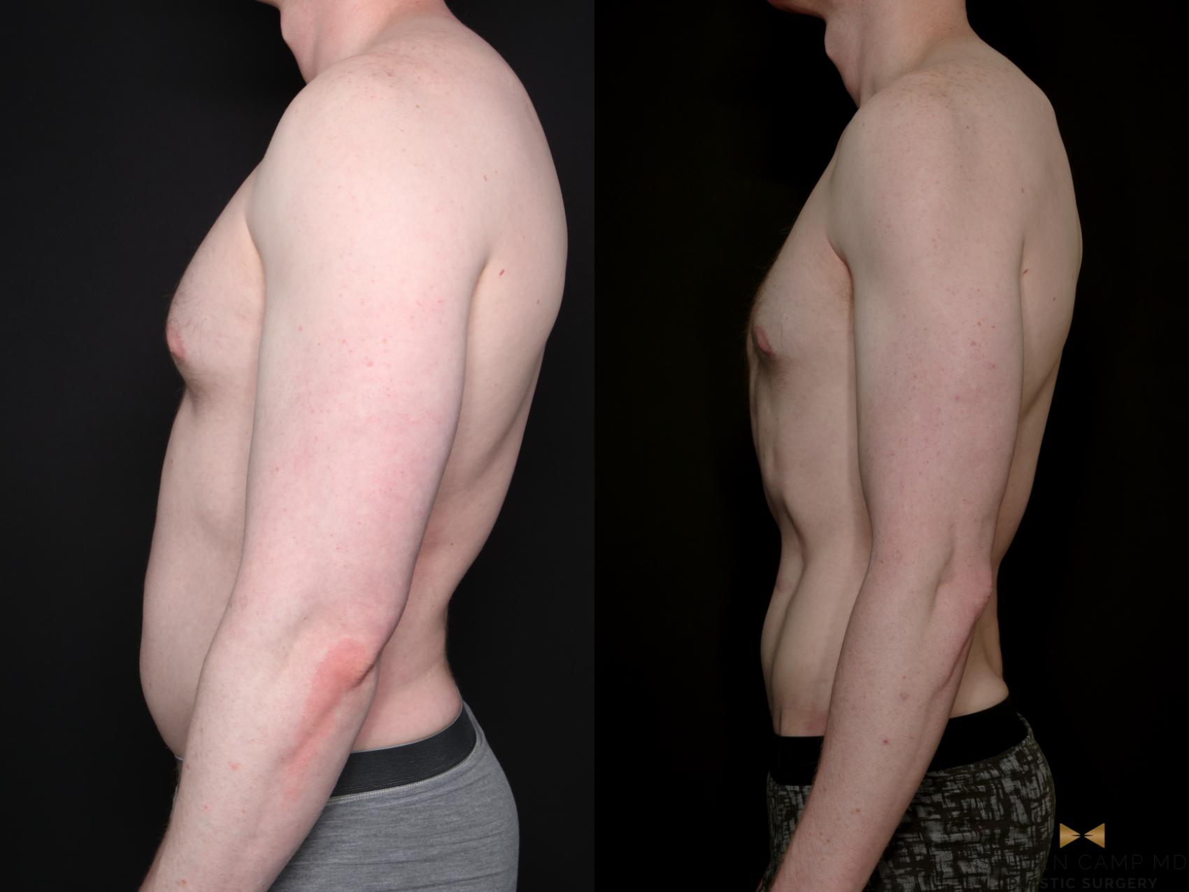 Before & After Liposuction Case 790 Left Side View in Fort Worth & Arlington, Texas