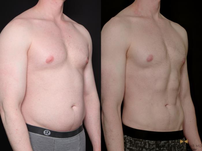 Before & After Liposuction Case 790 Right Oblique View in Fort Worth & Arlington, Texas