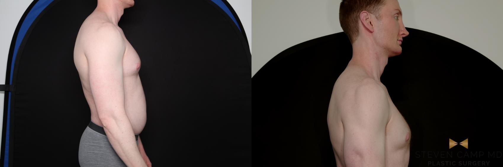 Before & After Liposuction Case 790 Right Side View in Fort Worth & Arlington, Texas