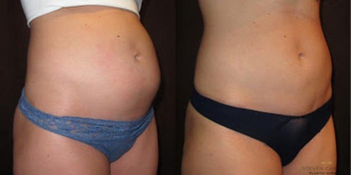 Before & After Liposuction Case 85 View #1 View in Fort Worth & Arlington, Texas