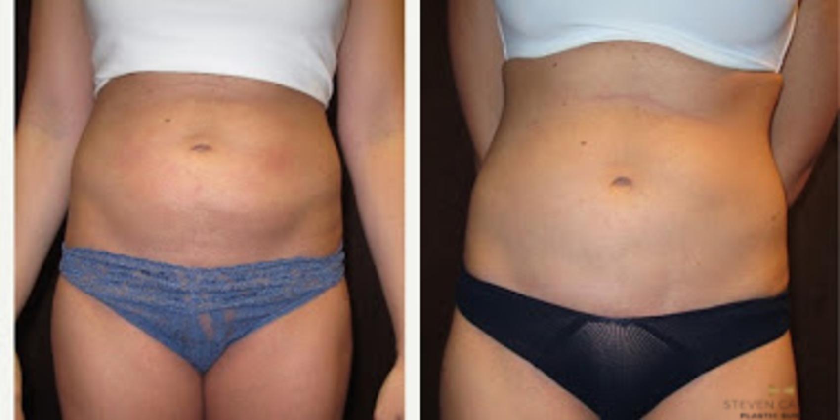 Before & After Liposuction Case 85 View #2 View in Fort Worth & Arlington, Texas
