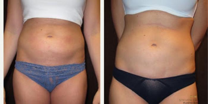Before & After Liposuction Case 85 View #2 View in Fort Worth & Arlington, Texas