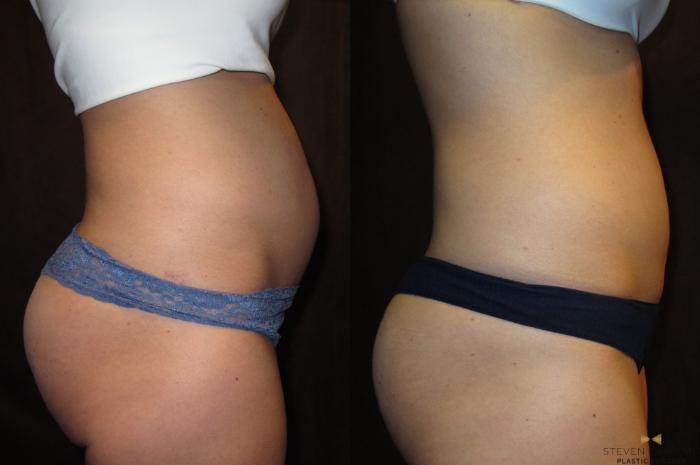 Before & After Liposuction Case 85 View #3 View in Fort Worth & Arlington, Texas