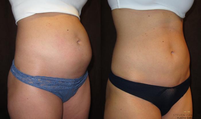 Before & After Liposuction Case 85 View #4 View in Fort Worth & Arlington, Texas