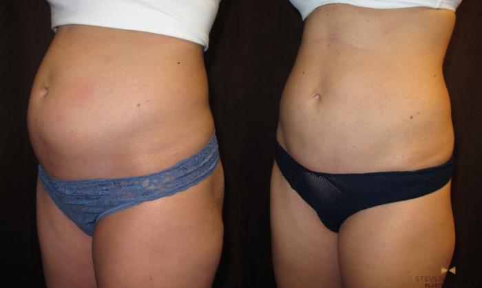 Before & After Liposuction Case 85 View #5 View in Fort Worth, Texas
