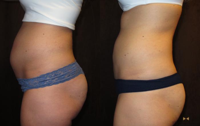 Before & After Liposuction Case 85 View #6 View in Fort Worth & Arlington, Texas