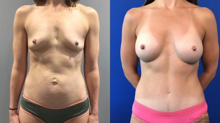 Before & After Liposuction Case 100 View #2 View in Fort Worth, Texas