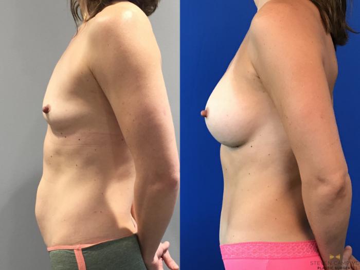Before & After Breast Augmentation Case 100 View #3 View in Fort Worth & Arlington, Texas