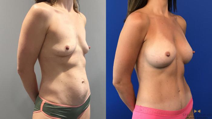 Before & After Breast Augmentation Case 100 View #4 View in Fort Worth & Arlington, Texas
