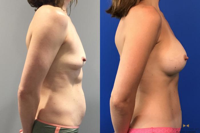 Before & After Liposuction Case 100 View #5 View in Fort Worth & Arlington, Texas