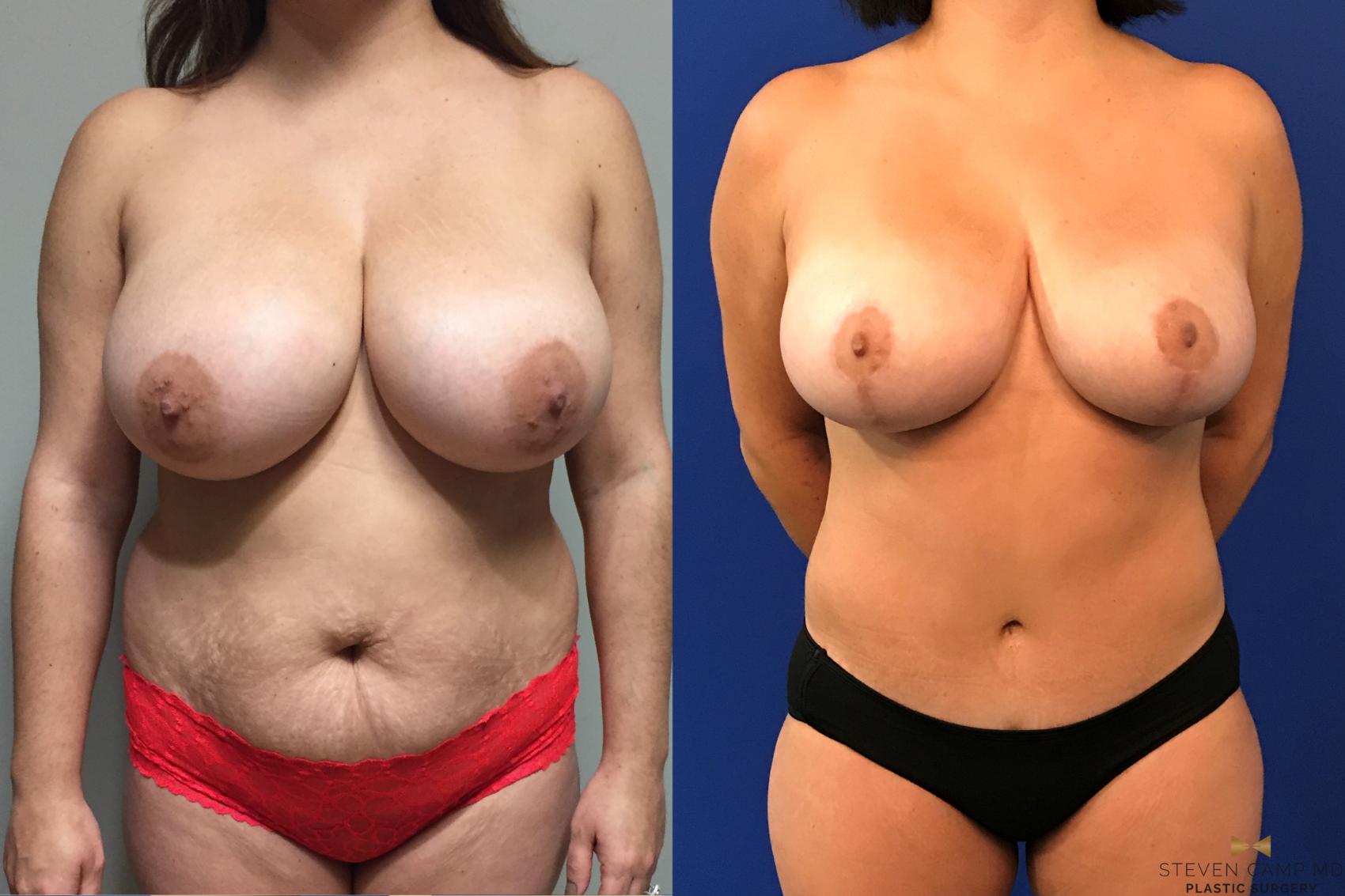 Before & After Tummy Tuck Case 137 View #1 View in Fort Worth, Texas