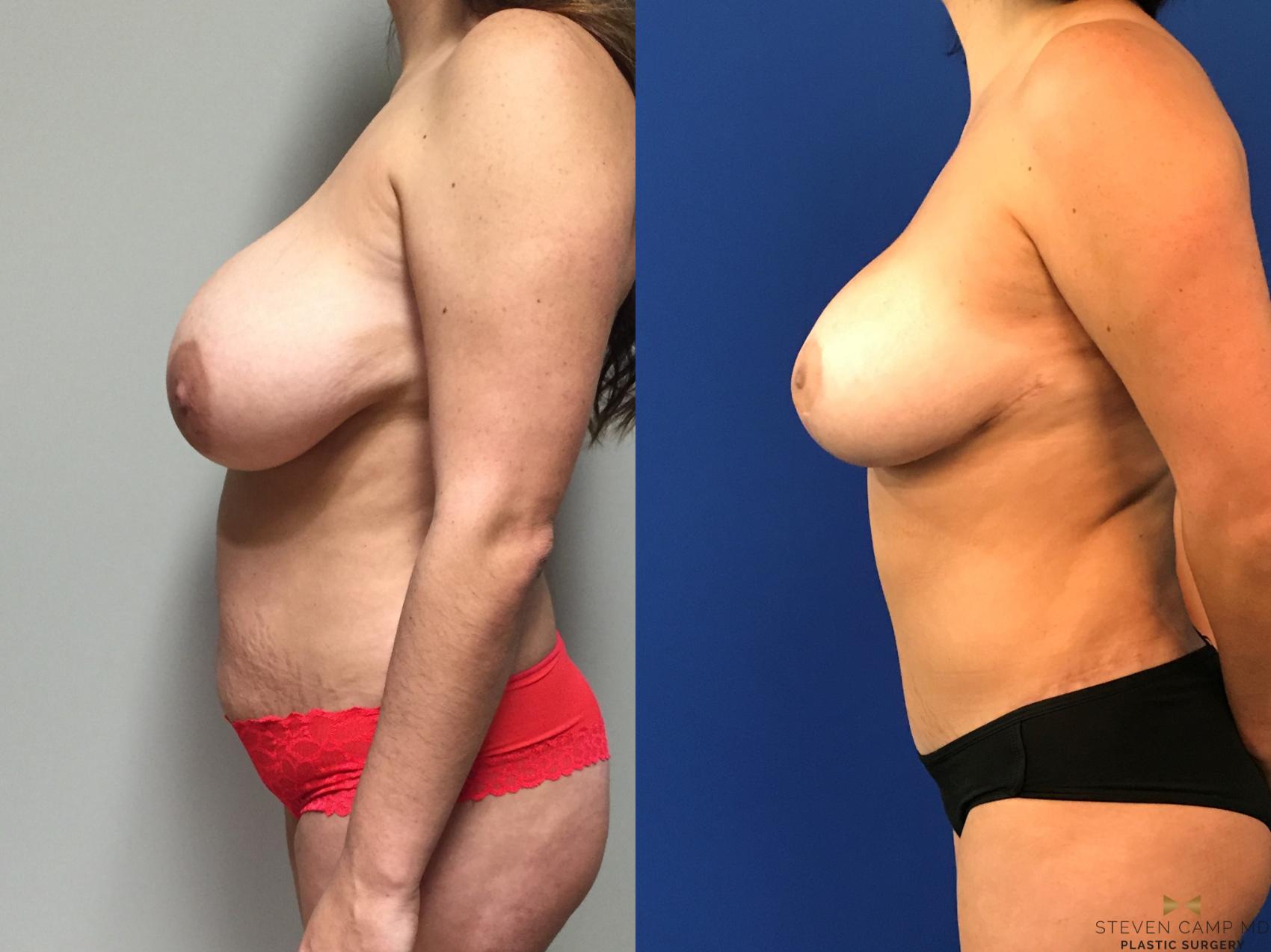 Before & After Mommy Makeover Case 137 View #3 View in Fort Worth & Arlington, Texas