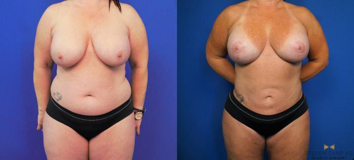 Before & After Breast Lift with or without Implants Case 173 View #1 View in Fort Worth, Texas