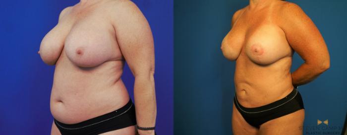 Before & After Breast Lift with or without Implants Case 173 View #2 View in Fort Worth, Texas