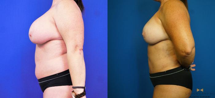 Before & After Breast Lift with or without Implants Case 173 View #3 View in Fort Worth, Texas