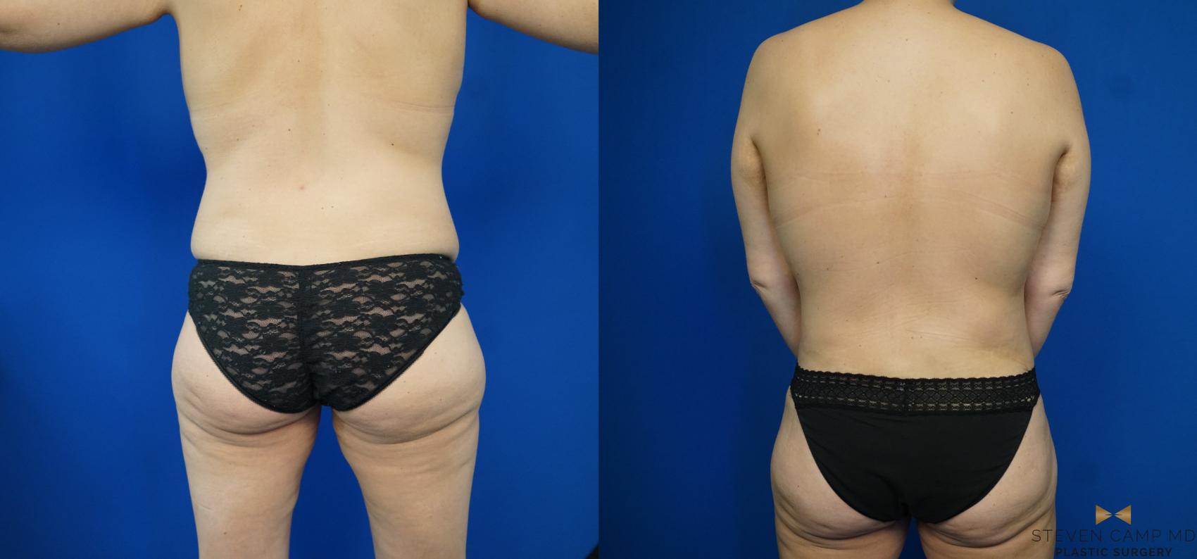 Before & After Mommy Makeover Case 185 View #8 View in Fort Worth & Arlington, Texas