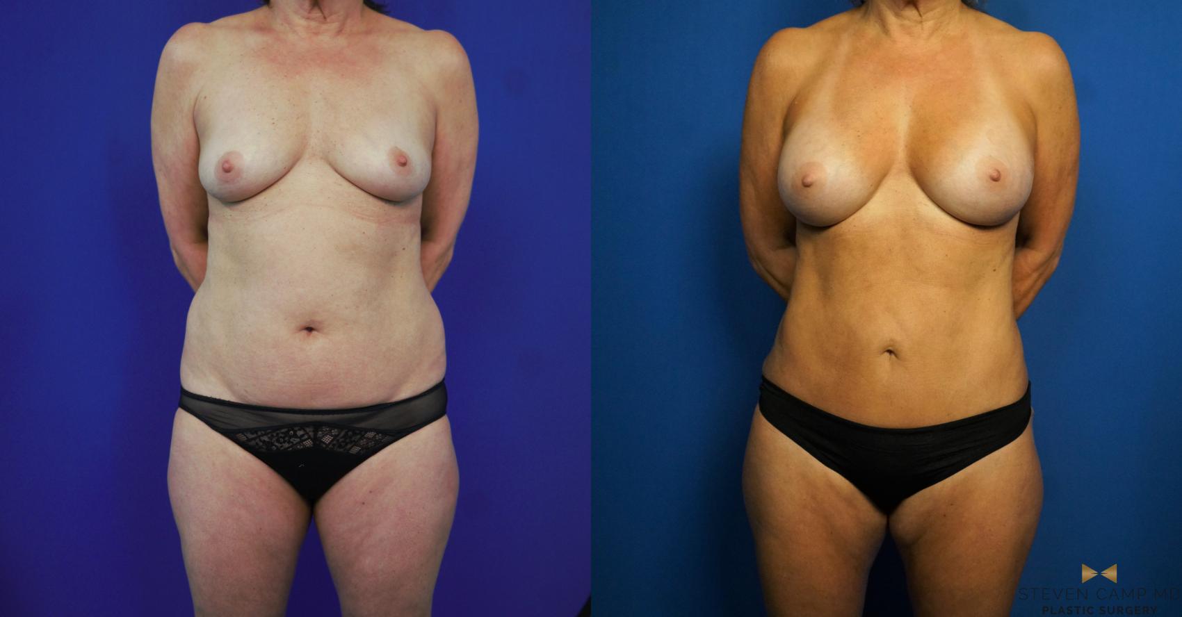 Before & After Case3108 by Steven Camp MD Plastic Surgery & Aesthetics, in Fort Worth