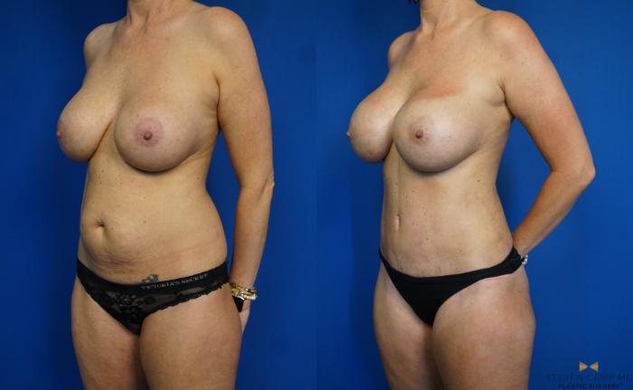 Before & After Breast Implant Exchange - NO LIFT  Case 310 View #2 View in Fort Worth & Arlington, Texas