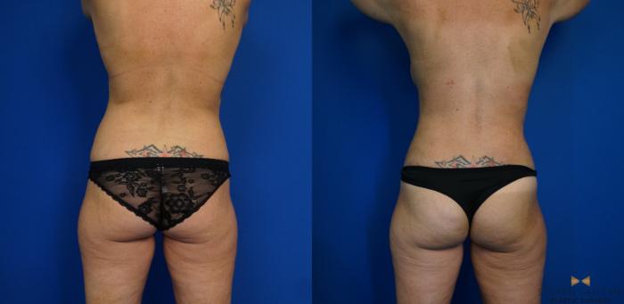 Before & After Breast Implant Exchange - NO LIFT  Case 310 View #5 View in Fort Worth & Arlington, Texas