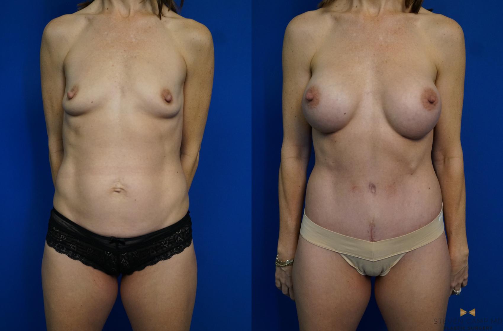 Before & After Mommy Makeover Case 312 View #1 View in Fort Worth & Arlington, Texas