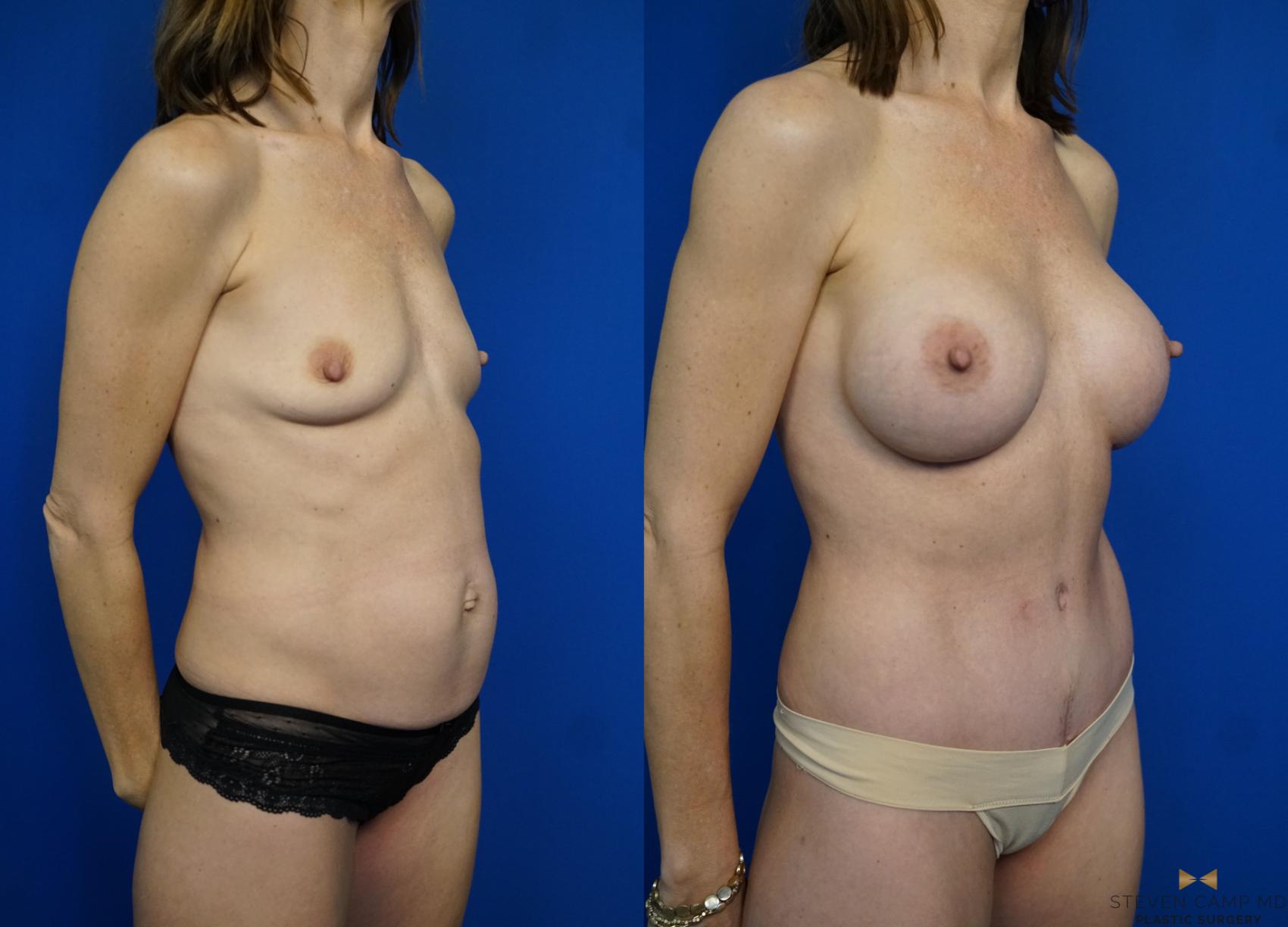 Before & After Liposuction Case 312 View #2 View in Fort Worth & Arlington, Texas
