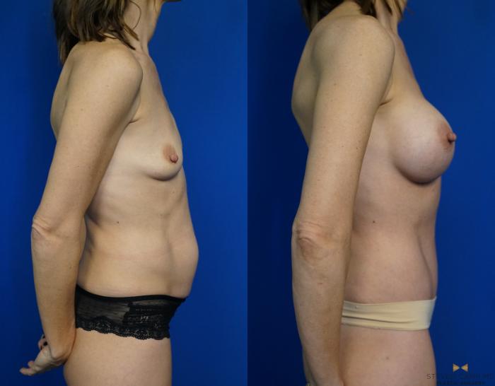 Before & After Breast Augmentation Case 312 View #3 View in Fort Worth, Texas