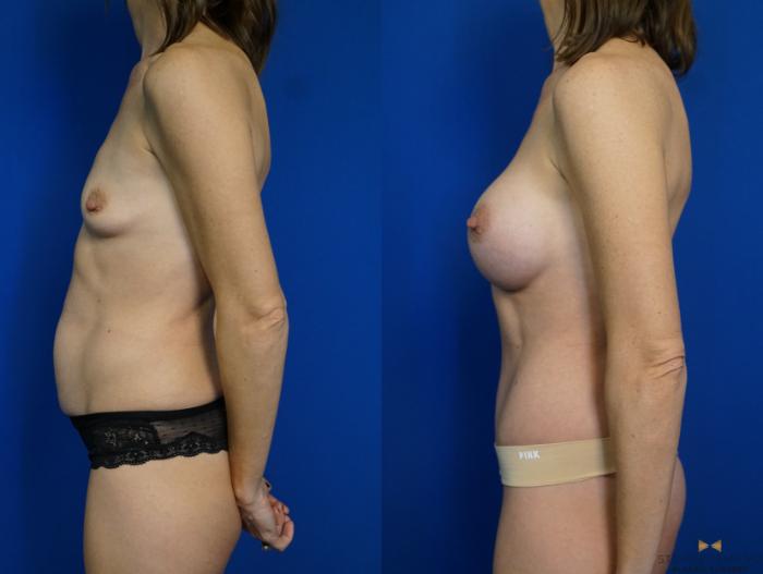 Before & After Breast Augmentation Case 312 View #5 View in Fort Worth, Texas