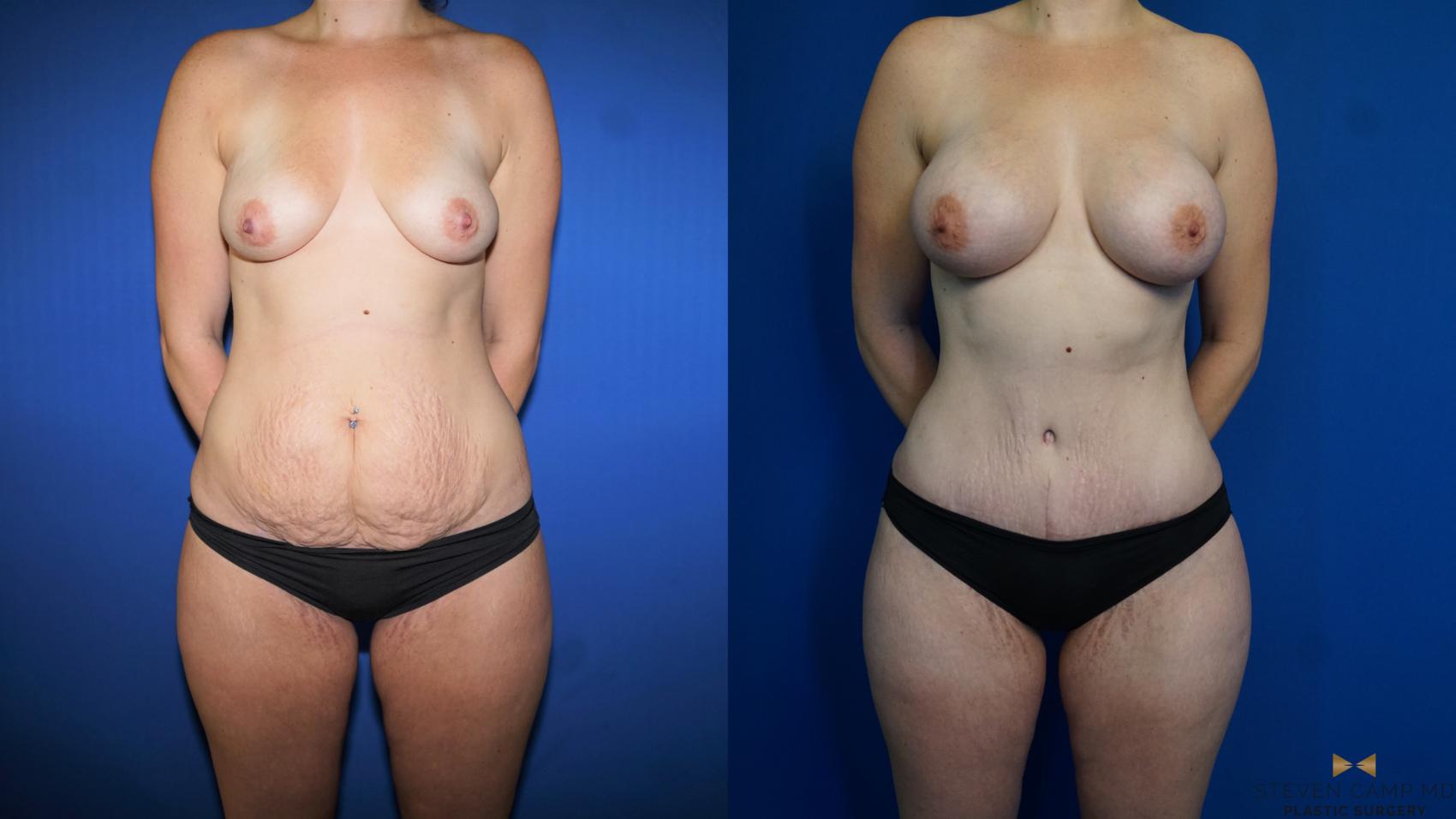 Before & After Liposuction Case 313 Front View in Fort Worth & Arlington, Texas