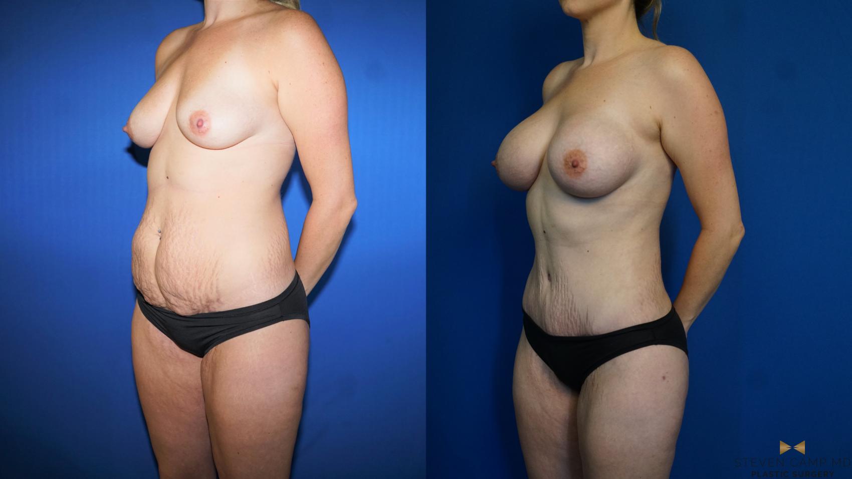 Before & After Mommy Makeover Case 313 Left Oblique View in Fort Worth & Arlington, Texas