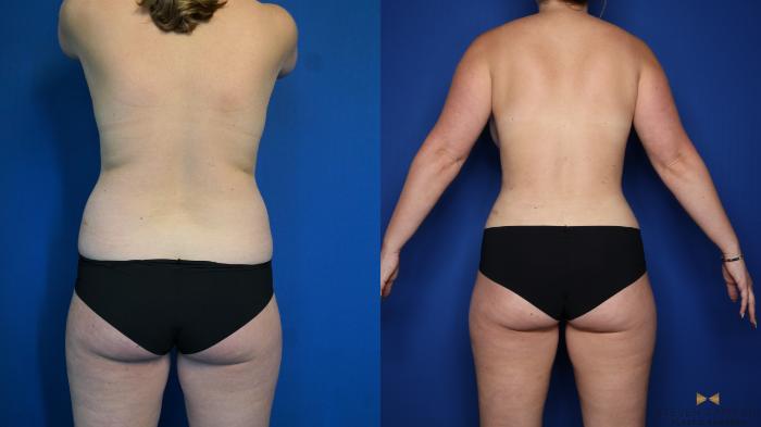 Before & After Breast Lift with or without Implants Case 316 Back View in Fort Worth, Texas