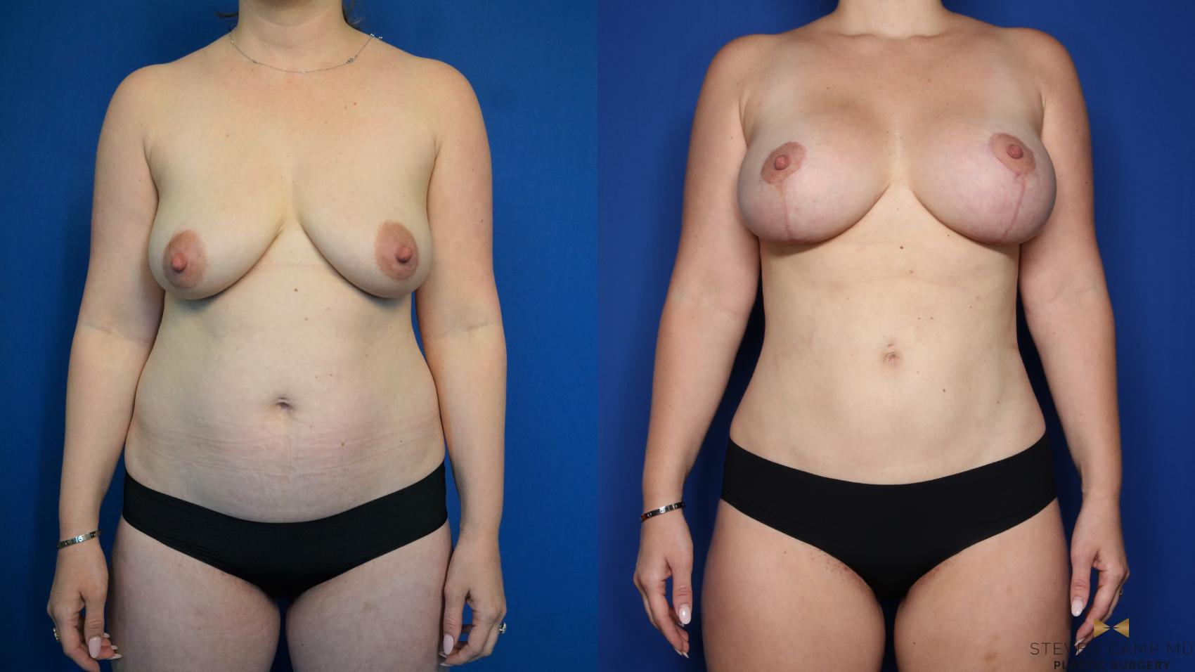 Before & After Tummy Tuck Case 316 Front View in Fort Worth, Texas