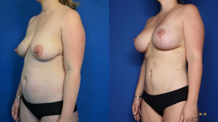 Before & After Breast Lift with or without Implants Case 316 Left Oblique View in Fort Worth, Texas