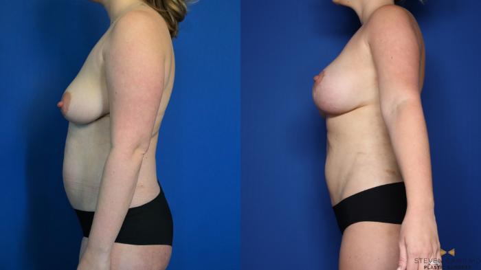Before & After Breast Lift with or without Implants Case 316 Left Side View in Fort Worth, Texas