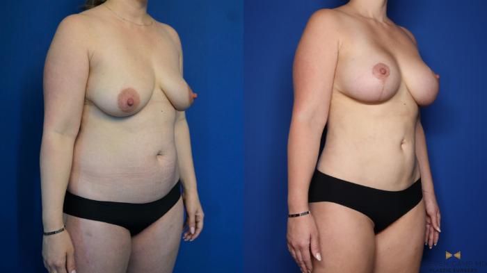 Before & After Mommy Makeover Case 316 Right Oblique View in Fort Worth, Texas
