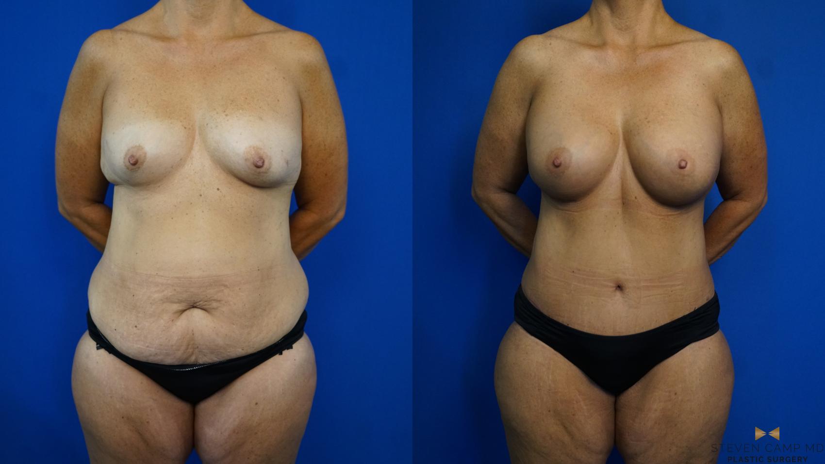 Before & After Liposuction Case 331 Front View in Fort Worth & Arlington, Texas