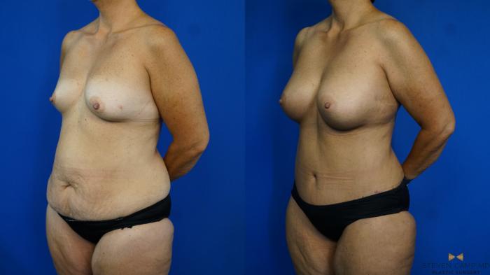 Before & After Mommy Makeover Case 331 Left Oblique View in Fort Worth & Arlington, Texas