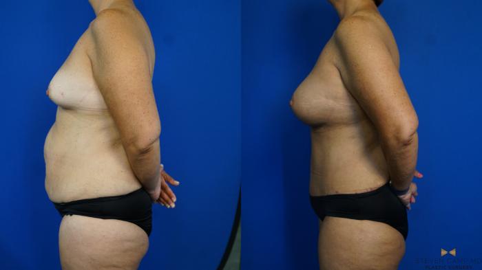 Before & After Mommy Makeover Case 331 Left Side View in Fort Worth & Arlington, Texas