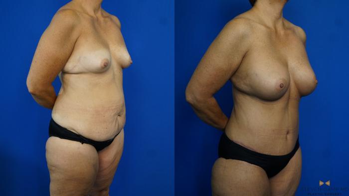Before & After Breast Augmentation Case 331 Right Oblique View in Fort Worth & Arlington, Texas