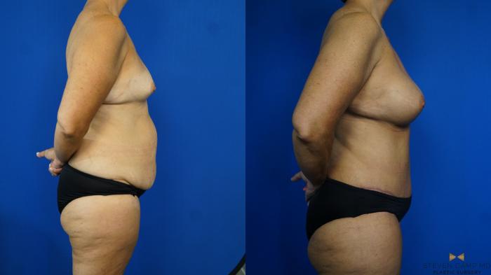Before & After Breast Augmentation Case 331 Right Side View in Fort Worth & Arlington, Texas