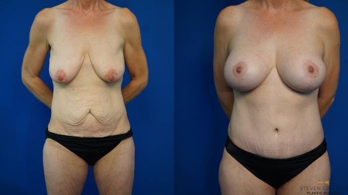 Before & After Breast Lift (Breast Mastopexy with Implants) Case 332 Front View in Fort Worth & Arlington, Texas