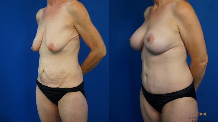 Before & After Mommy Makeover Case 332 Left Oblique View in Fort Worth & Arlington, Texas