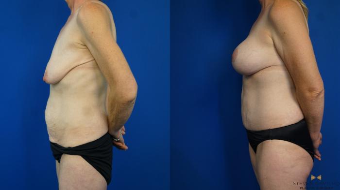 Before & After Tummy Tuck Case 332 Left Side View in Fort Worth & Arlington, Texas