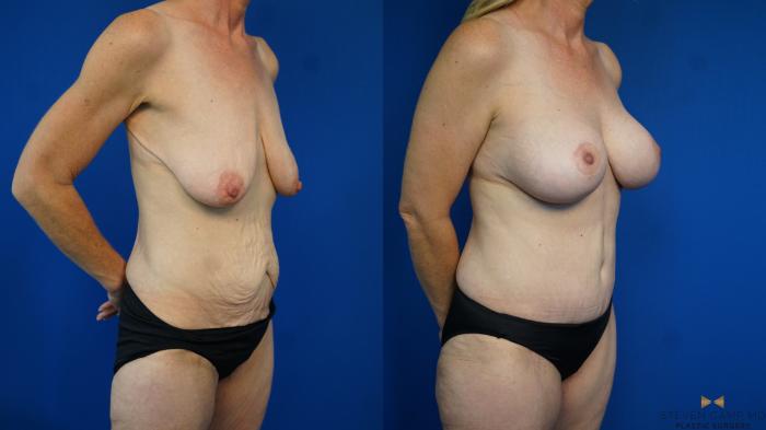Before & After Breast Lift (Breast Mastopexy with Implants) Case 332 Right Oblique View in Fort Worth & Arlington, Texas