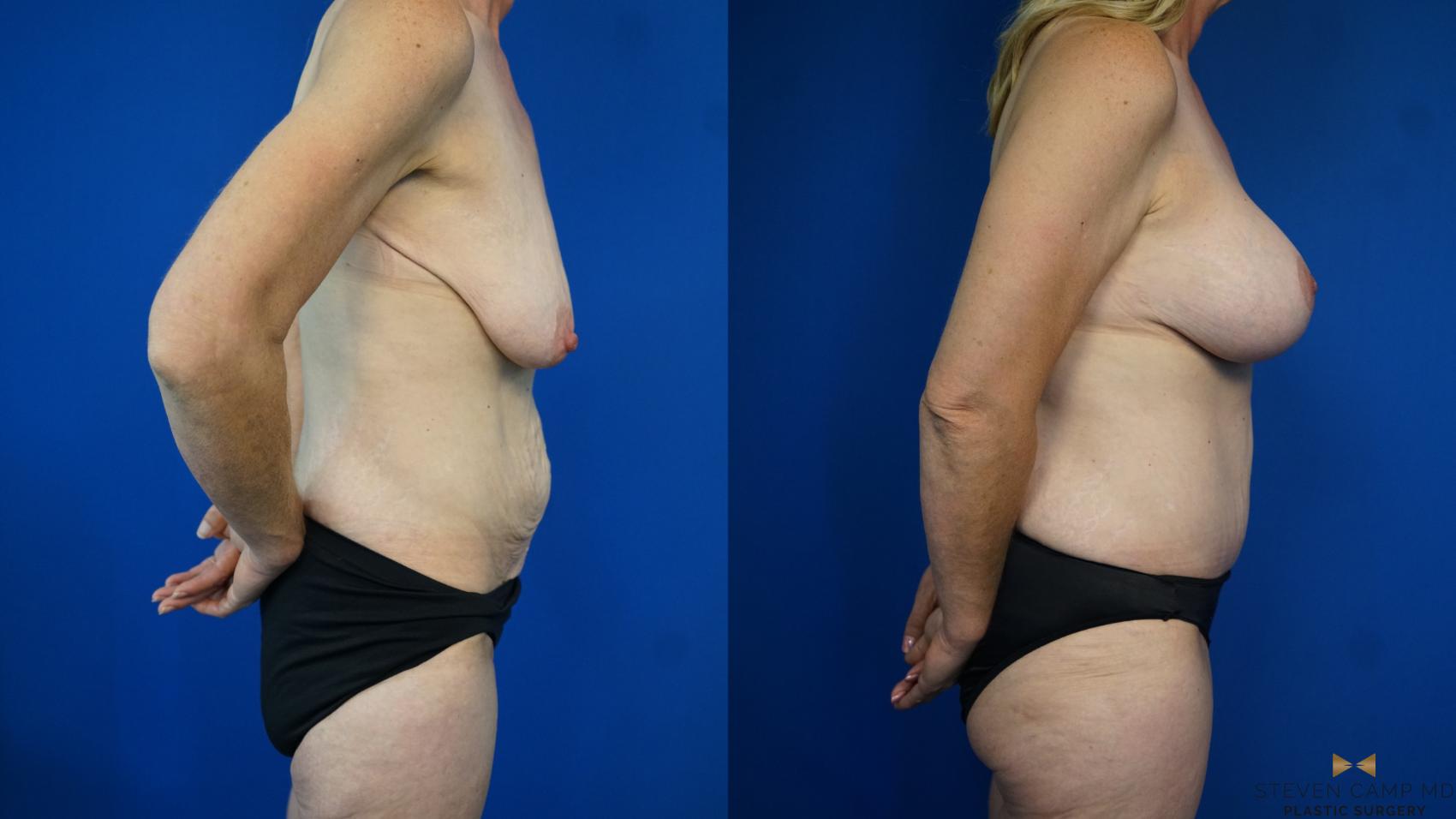 Before & After Mommy Makeover Case 332 Right Side View in Fort Worth & Arlington, Texas