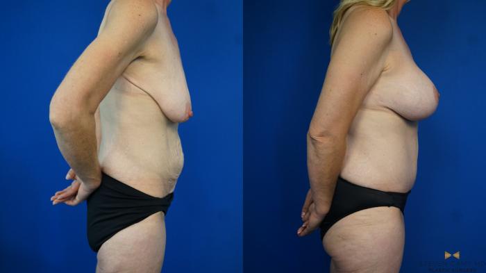 Before & After Tummy Tuck Case 332 Right Side View in Fort Worth & Arlington, Texas