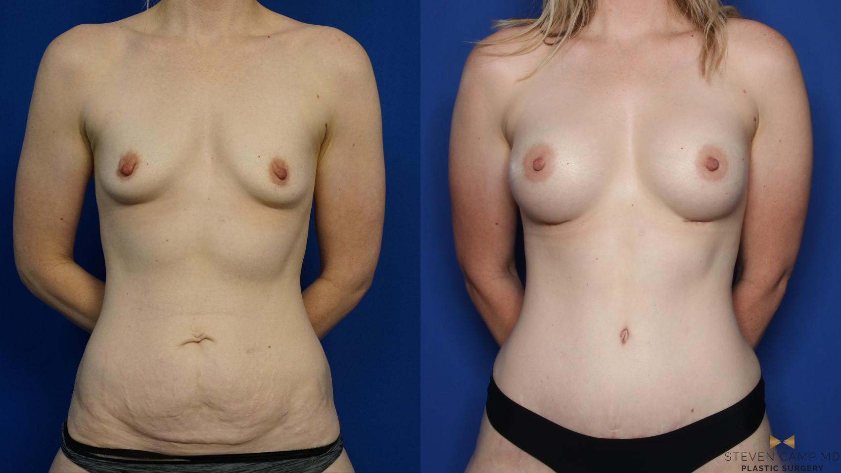 Before & After Tummy Tuck Case 378 Front View in Fort Worth & Arlington, Texas