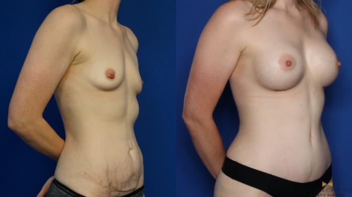 Before & After Liposuction Case 378 Left Oblique View in Fort Worth & Arlington, Texas