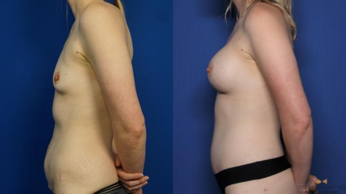 Before & After Liposuction Case 378 Left Side View in Fort Worth & Arlington, Texas